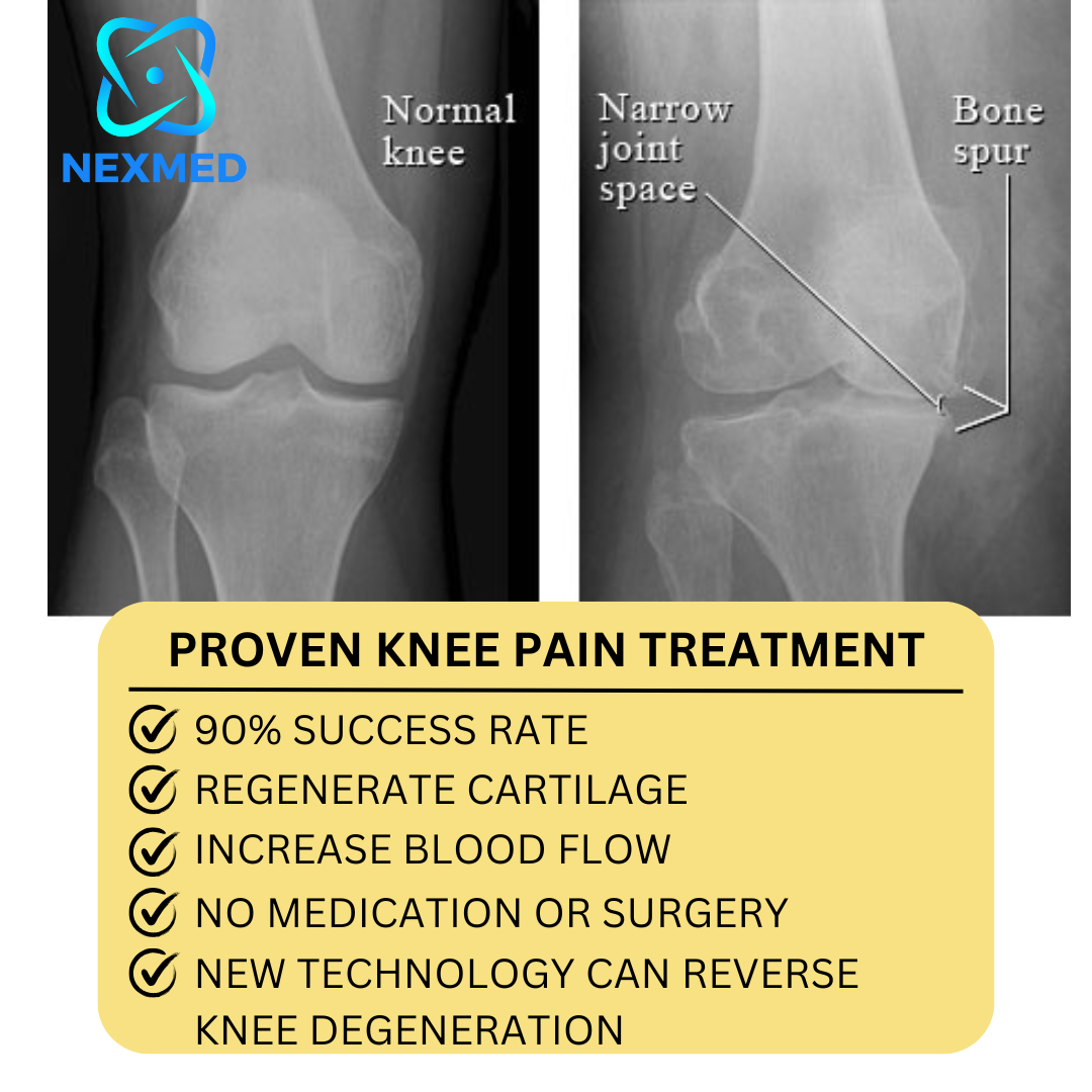 NexMed Ormond Facebook ad: Another Year of Knee Pain?