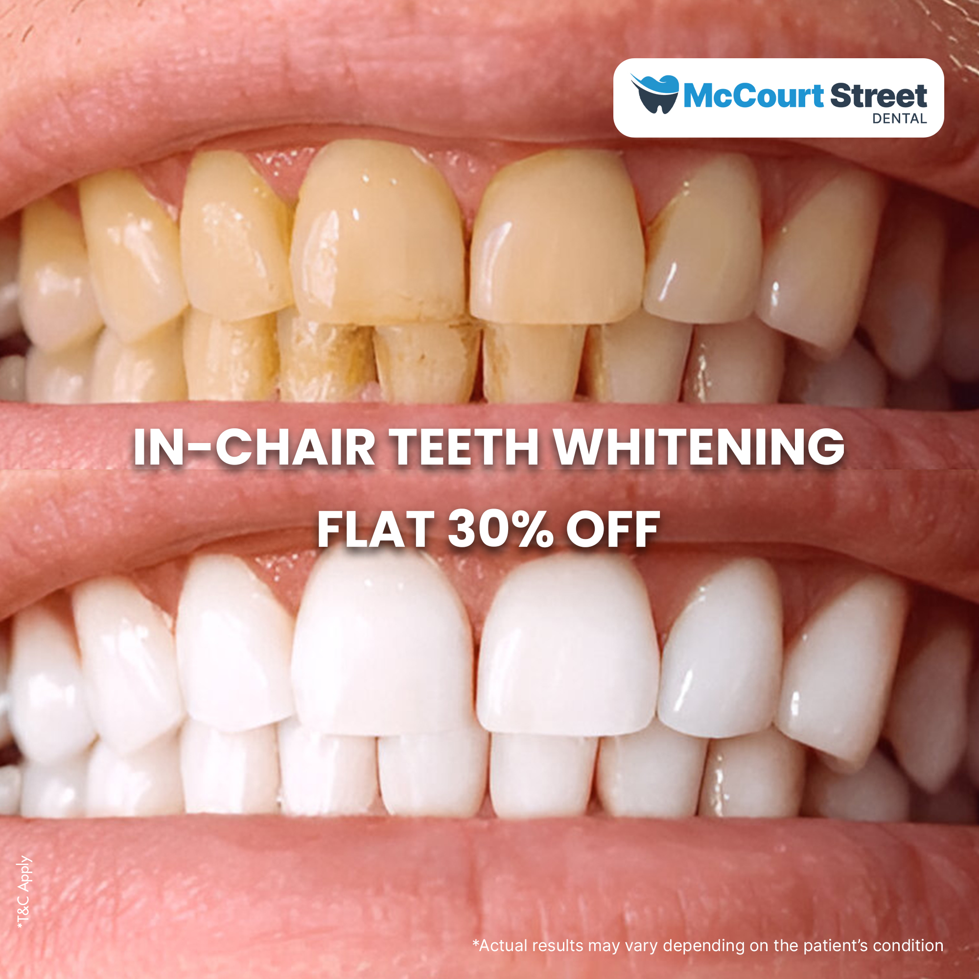 McCourt Street Dental Clinic Facebook ad: In-Chair Teeth Whitening FLAT 30% OFF Only at…