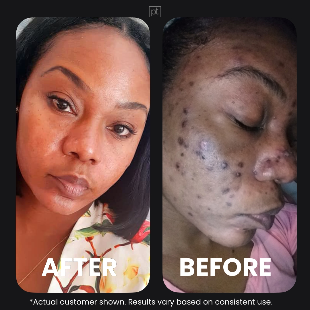 Perfec-Tone Facebook ad: Let Us Handle Your Skin