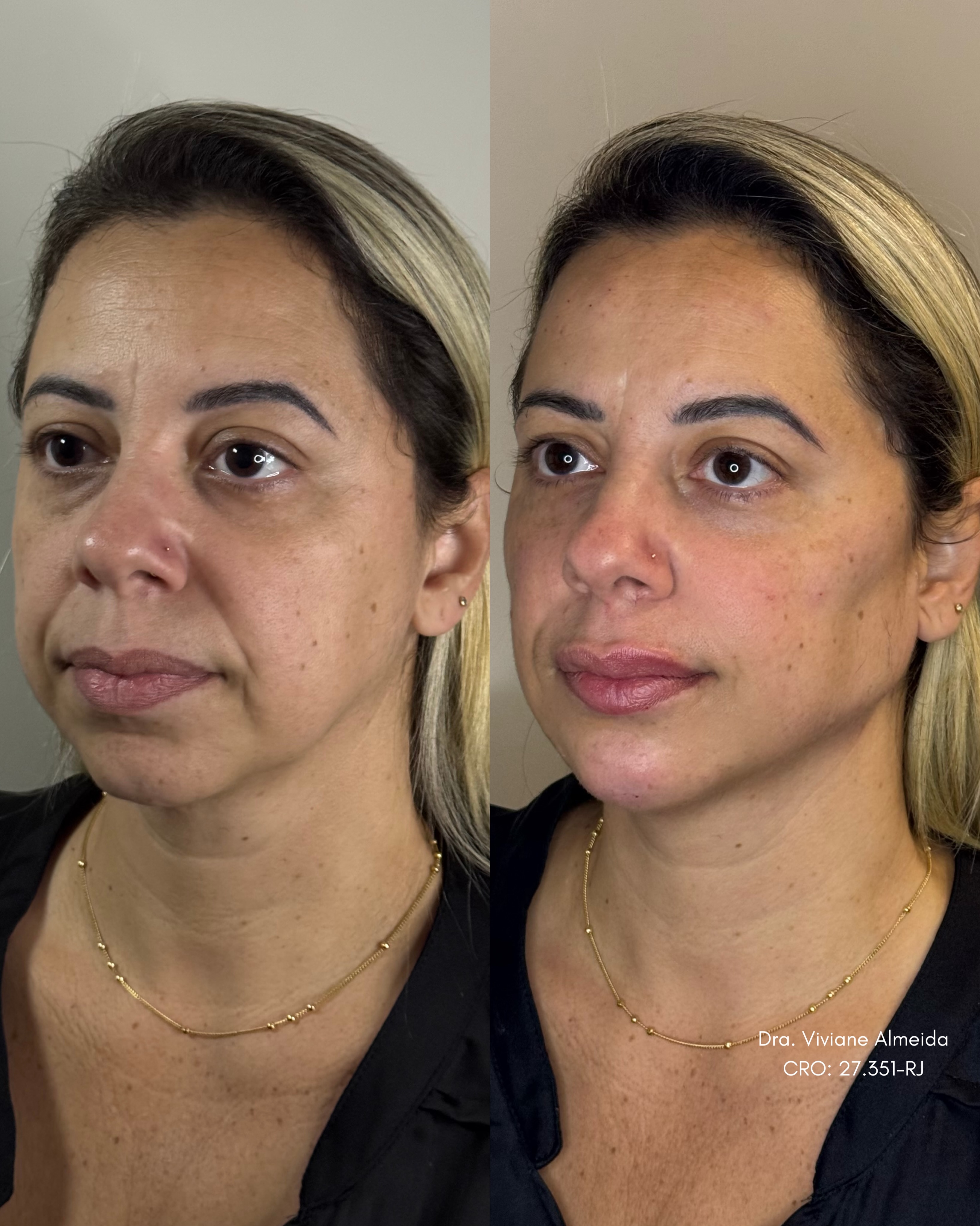 Instituto Viviane Almeida Facebook ad: Depois de um grande emagrecimento e das marcas…
