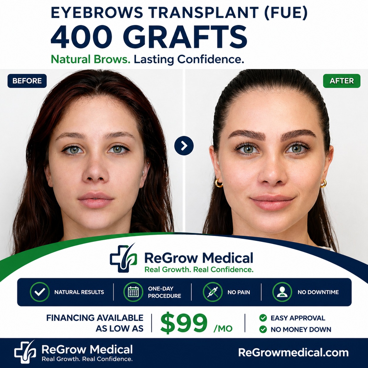 ReGrow Medical Facebook ad: FUE Eyebrow Transplant, Permanent. Natural. One Day.