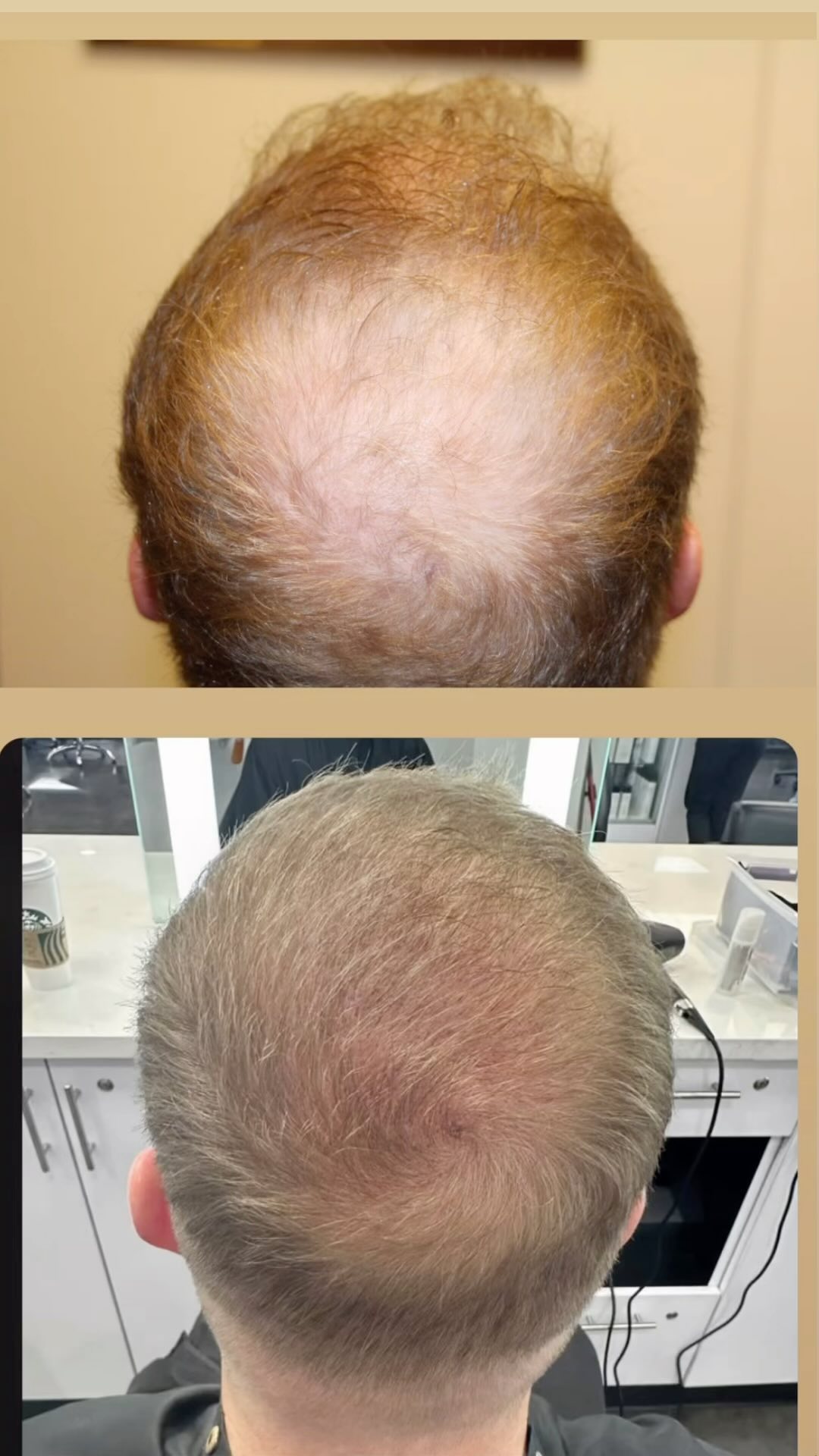 Modena Hair Institute Facebook ad: Check out these early results for this patient