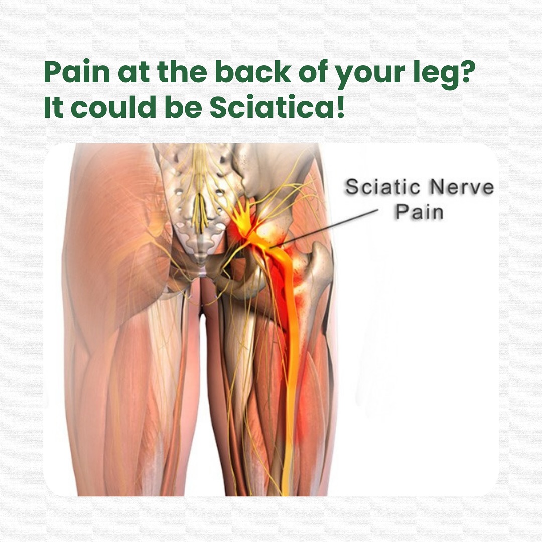 Orchard Health Clinic Facebook ad: Did you know - Sciatica affects nearly 40%…