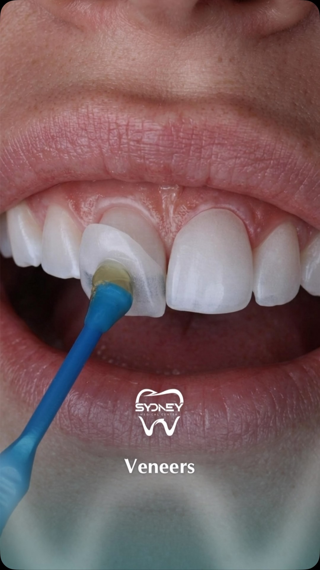 Sydney Dental Facebook ad: فينير الأسنان بدون حف