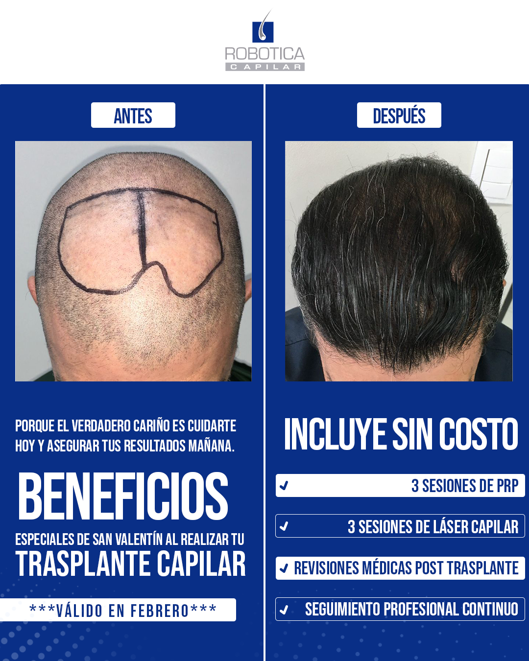 Robotica Capilar · Trasplante Capilar · Hair Restoration · Rejuvenecimiento Facebook ad