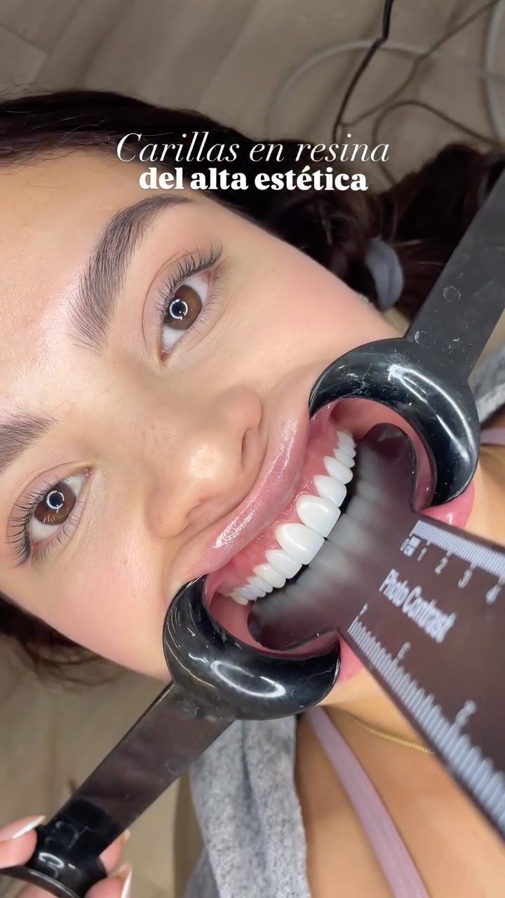 Sonrisa Perfecta Facebook ad: Diseño de sonrisa con carillas de resina Transforma…