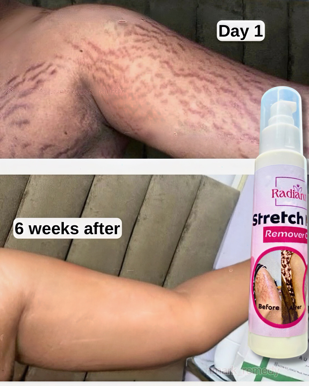 Clear stretch marks Facebook ad: Erase stretch marks in just 30 days