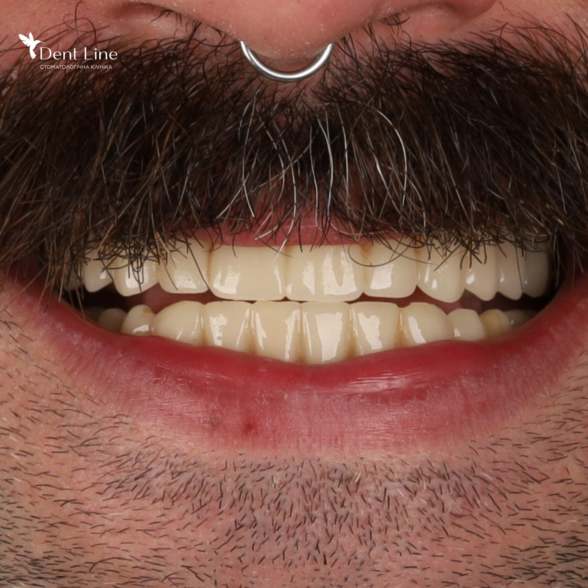 Dent Line Clinic Facebook ad: Детальніше на сайті