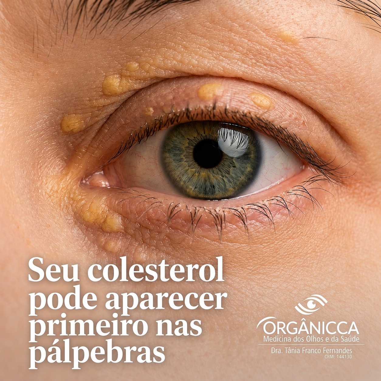 Orgânicca - Medicina dos Olhos e da Saúde Facebook ad: Pequenas placas amareladas ao redor dos olhos podem…
