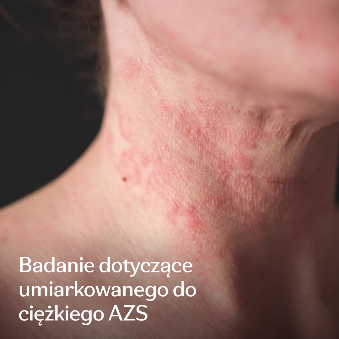 Eczema Research Study Facebook ad: Dołącz do badania nad AZS