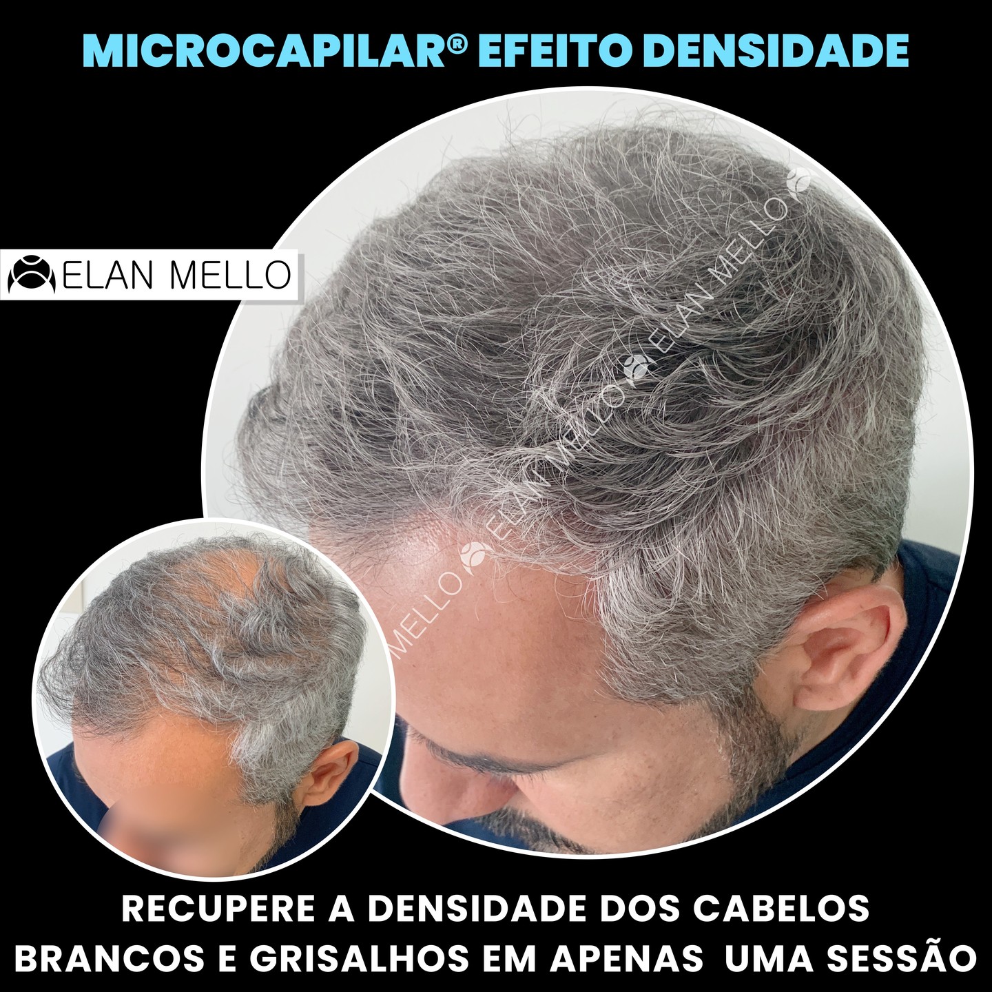 Vanessa Mello Art, By Elan Mello. Facebook ad: Microcapilar: A solução definitiva para sua densidade…