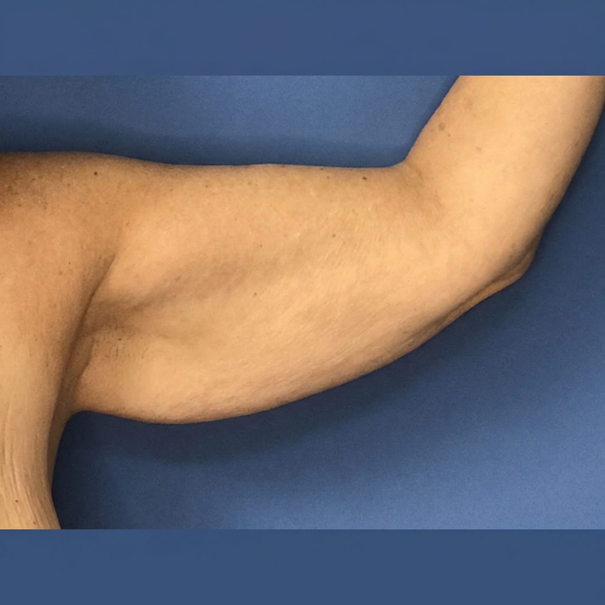 Marc Sturman Facebook ad: For years my arms looked like this.