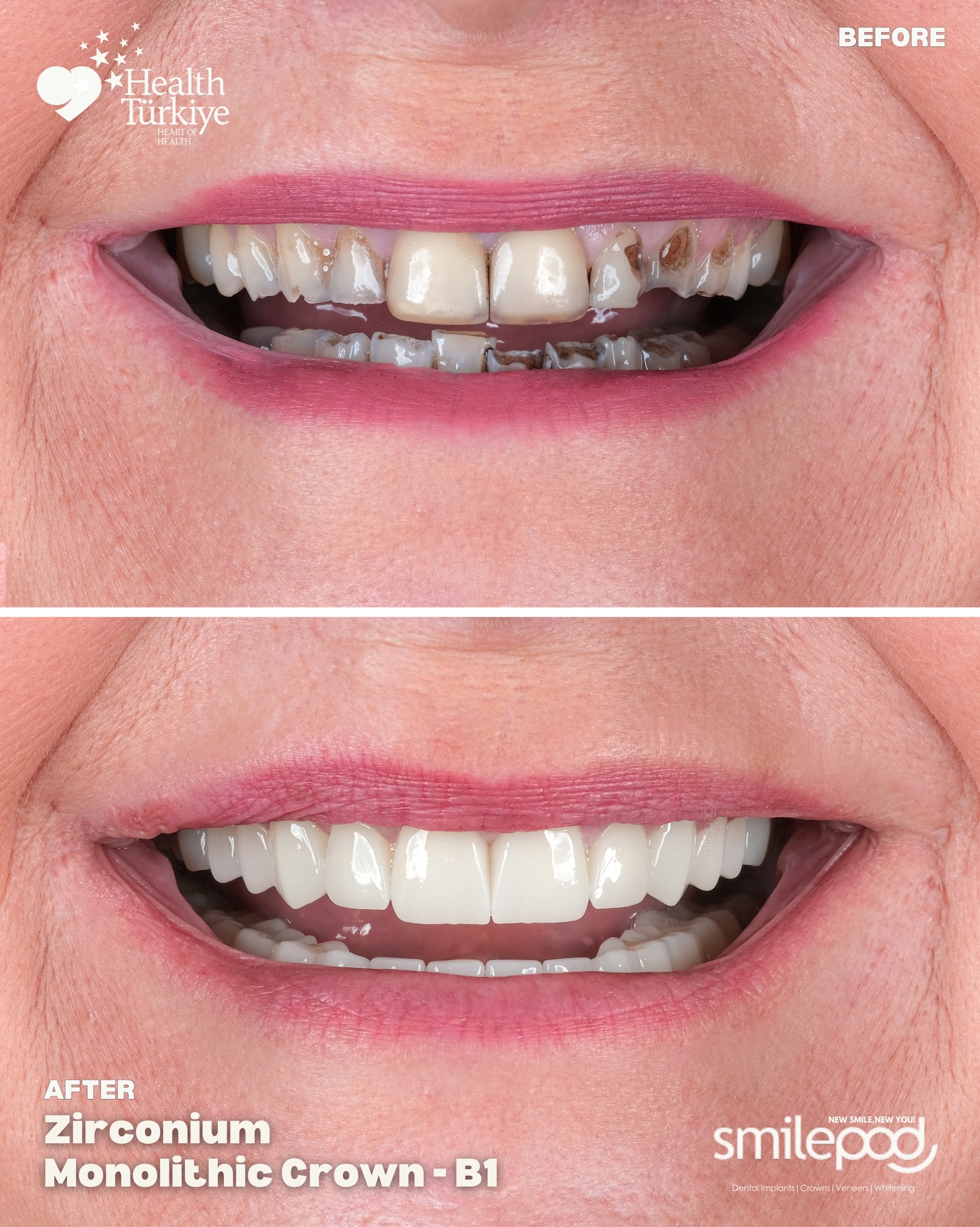Smilepod Dental Clinic Turkey Facebook ad: I don’t want ‘Turkey Teeth’.