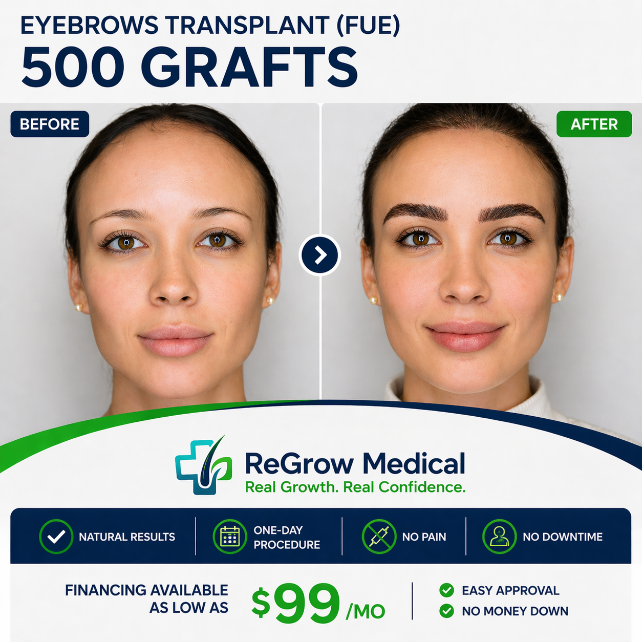 ReGrow Medical Facebook ad: FUE Eyebrow Transplant, Permanent. Natural. One Day.