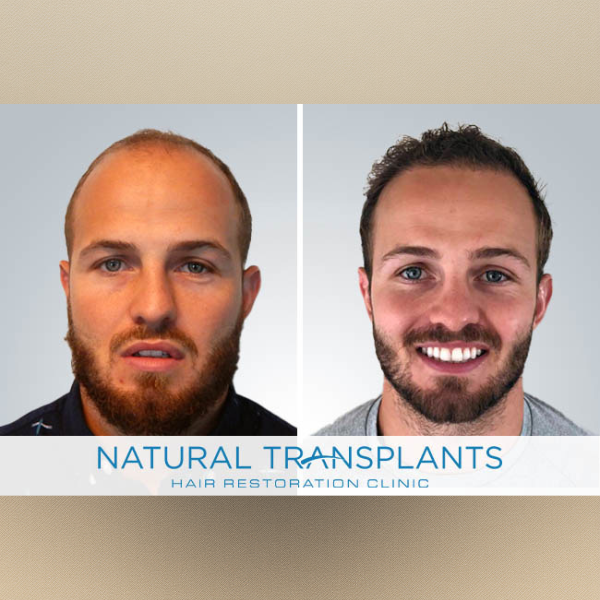 Natural Transplants, Hair Restoration Clinic Facebook ad: Trusted by 6,000+ patients