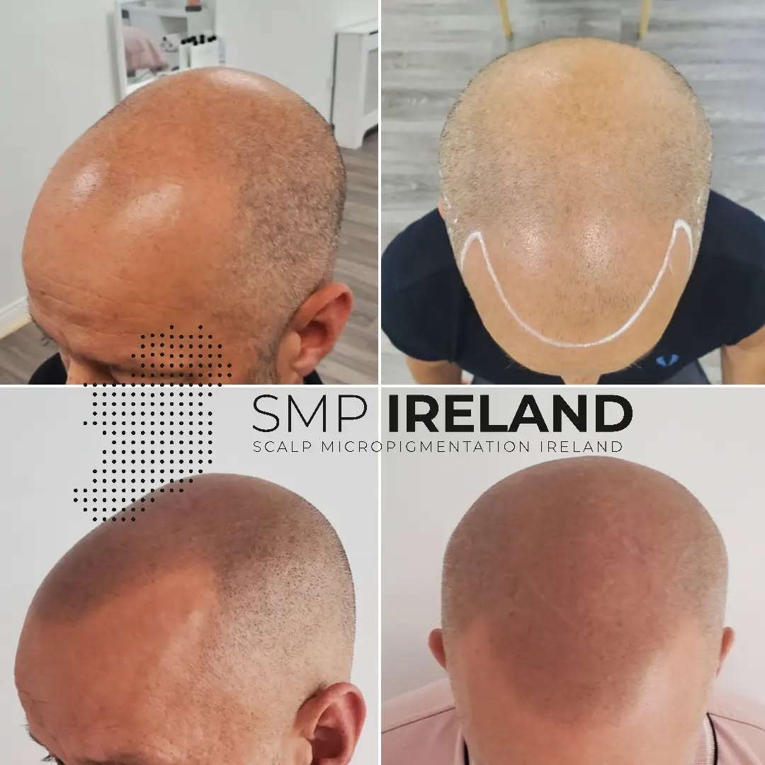 SMP Ireland, Scalp Micropigmentation Ireland Facebook ad from Nov 9, 2025