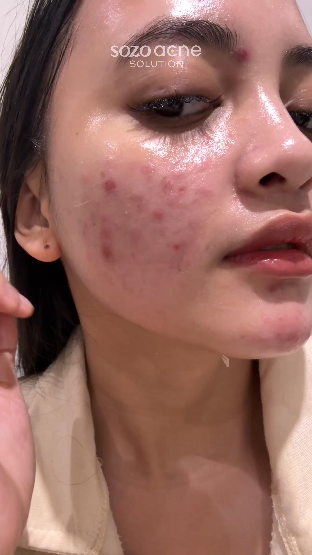 Sozo Skin Clinic Facebook ad: IPL Acne 199rb