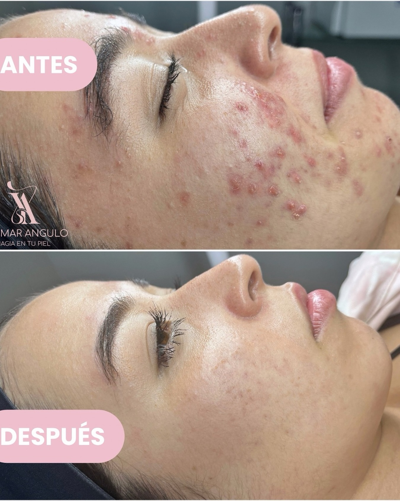 Magiaentupiel.ya Facebook ad: Michelle llegó a nuestra estética con un fuerte…