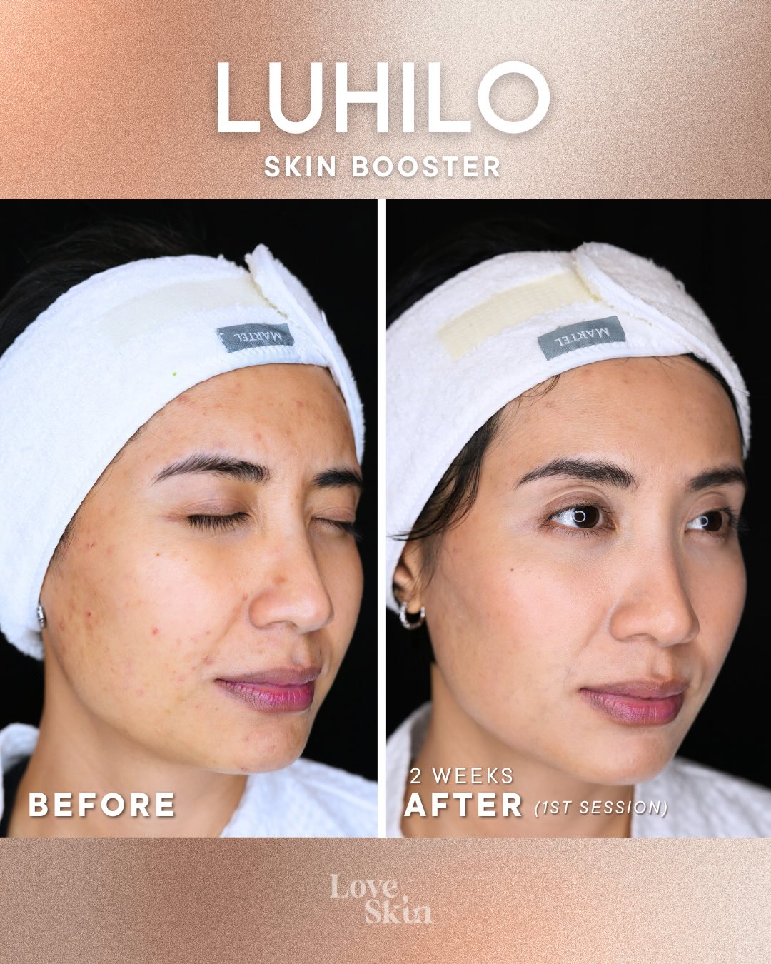 Love, Skin Clinic Facebook ad: Two weeks can make a difference