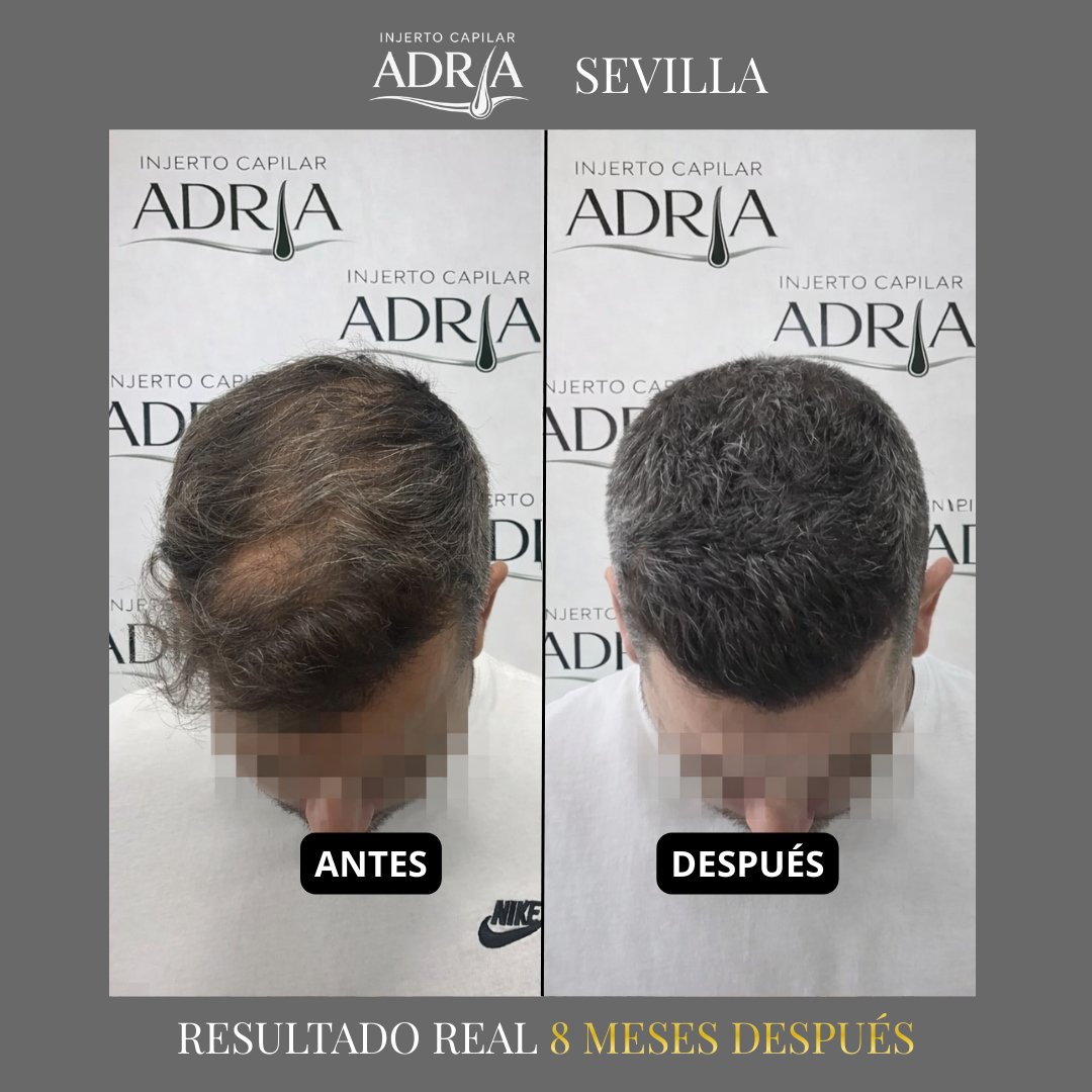 Injerto Capilar Adria Facebook ad