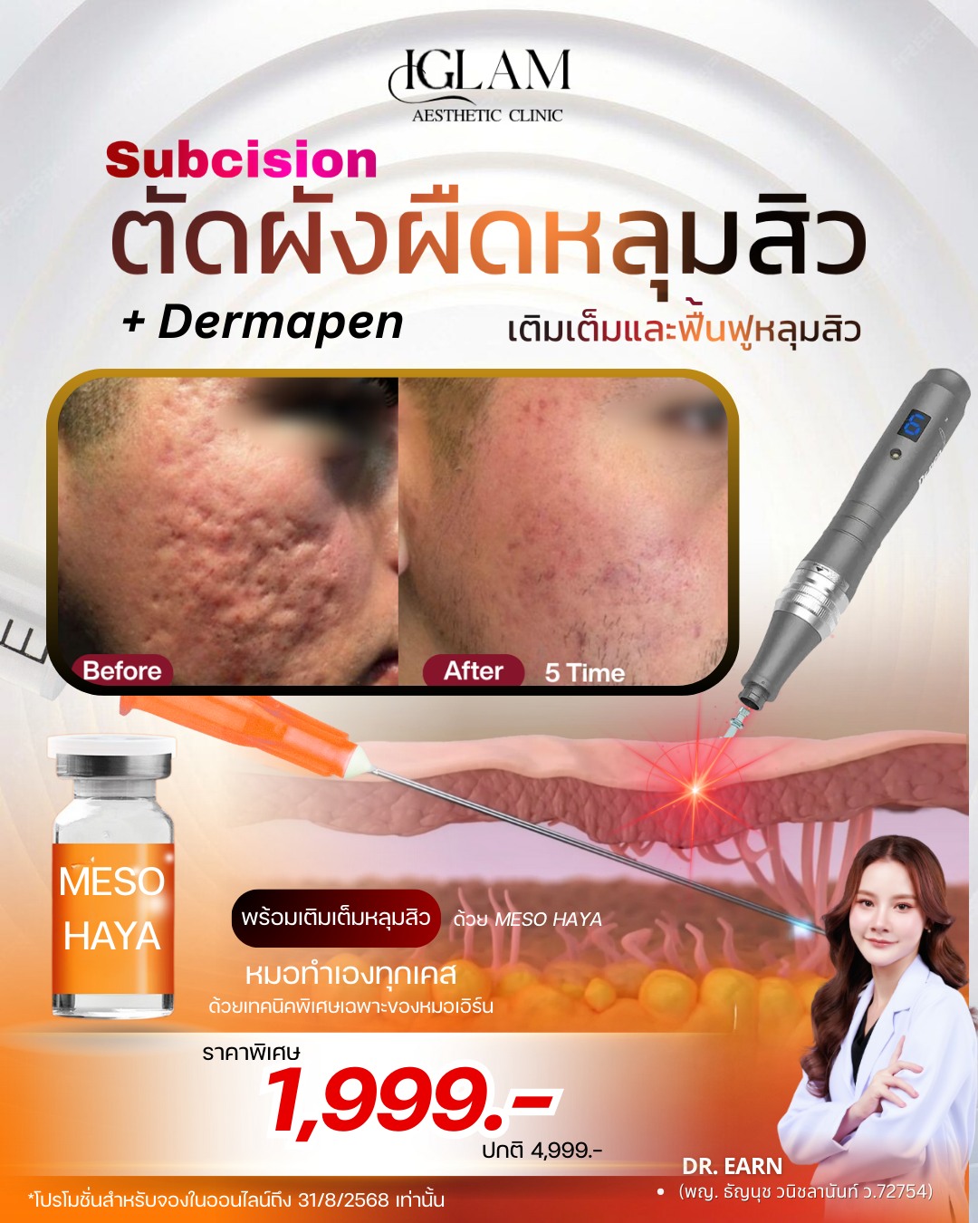Iglam clinic ระยอง ฟิลเลอร์ โบท็อก Facebook ad