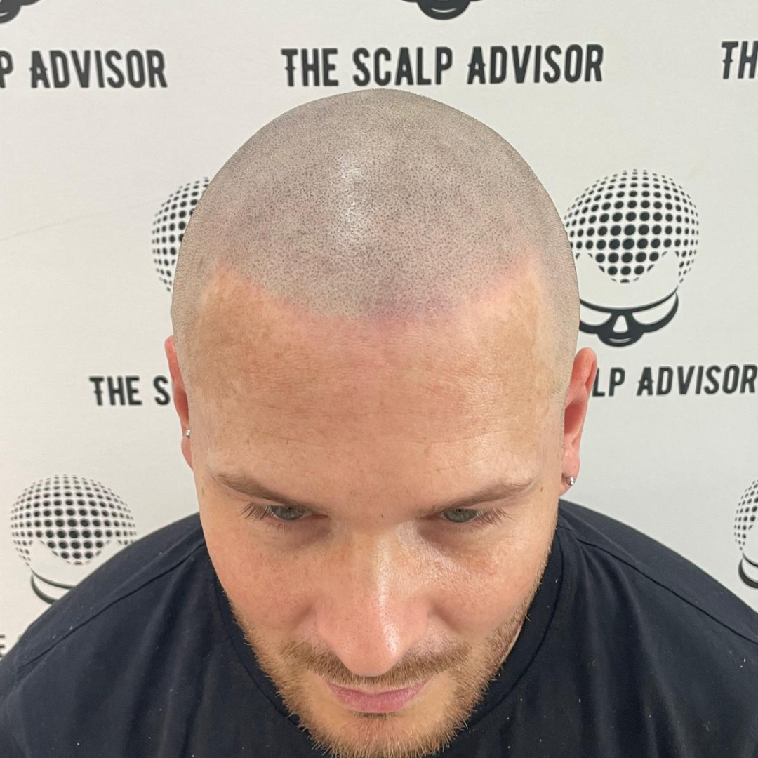 The Scalp Advisor Facebook ad: Suffering from hair loss or baldness?