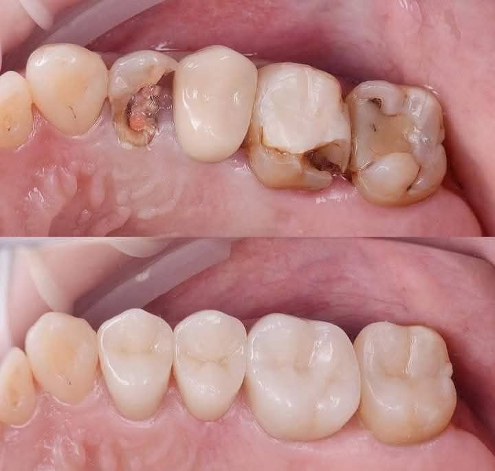 Smiles Dental Clinic 2 Facebook ad: Severe tooth decay?