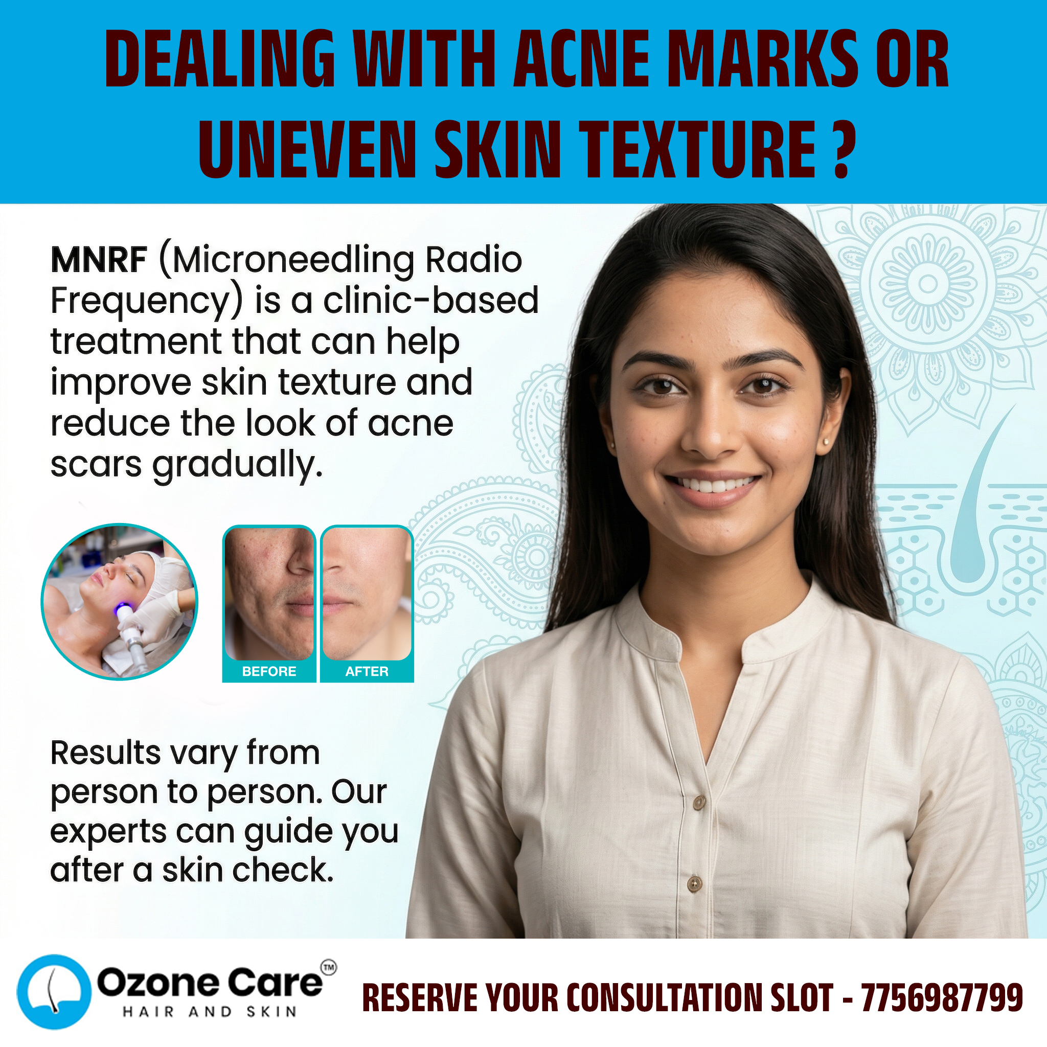 Ozone Care Clinic Seawoods, Navi Mumbai Facebook ad: Acne Marks Ko Kaise Treat Karein?