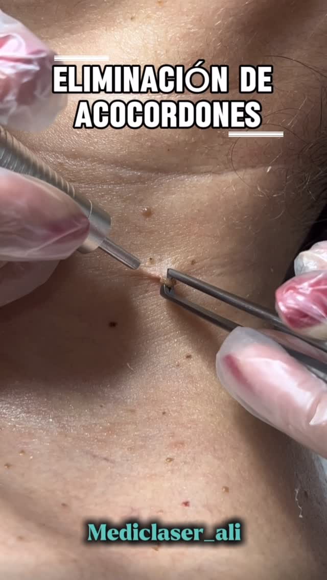 MedicLaser Facebook ad: El retiro de acrocordones ( péquelas verrugas blandas)…