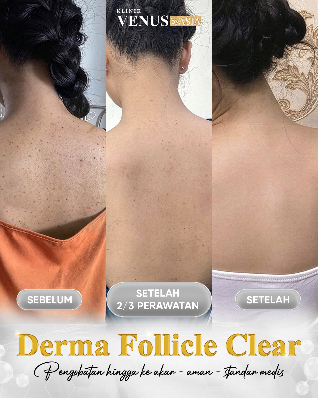 Derma Follicle - Venus by Asia Facebook ad: HASIL PERAWATAN FOLIKULITIS PUNGGUNG SETELAH 1 RANGKAIAN