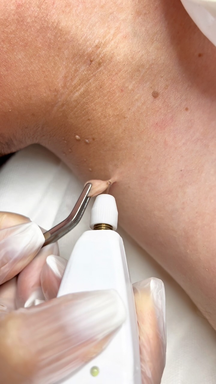 Dr.Fexriyye Fotona Lazer Facebook ad: Plexrlə akroxardonların dermatoskopiyadan sonra götürülməsi.