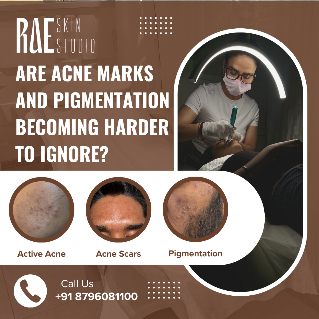 Rae Skin Studio Facebook ad: Get The Best Acne Treatment at Rae Skin Studio