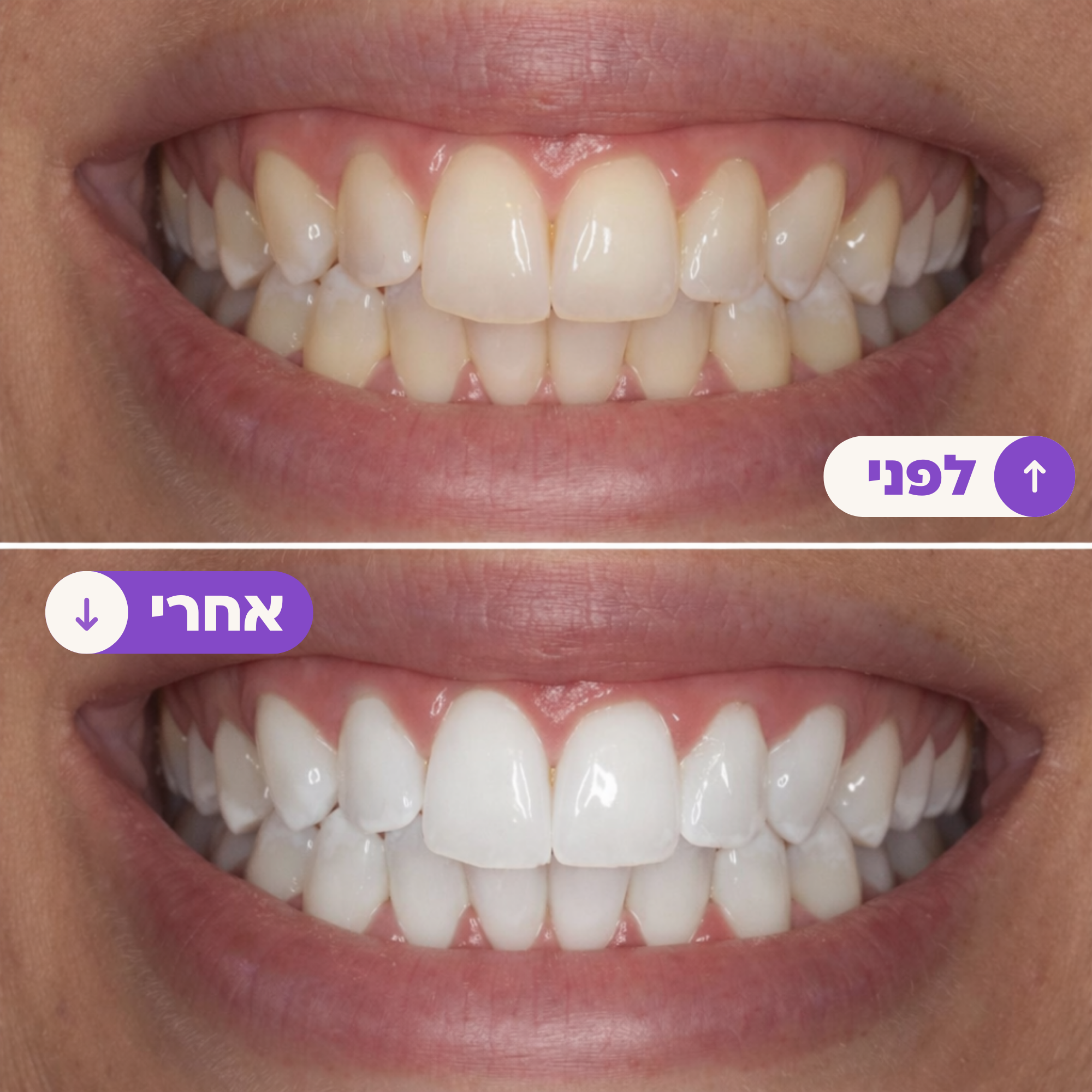 המלצות על הלבנת שיניים Facebook ad: ניסיתם רצועות הלבנה בעבר ושנאתם את הרגישות? זה שונה