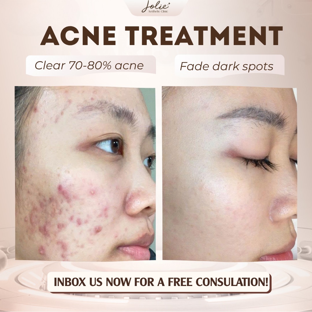 Thoi trang cao cap Facebook ad: CLEAR SKIN, REBORN WITH MEDICAL PEEL