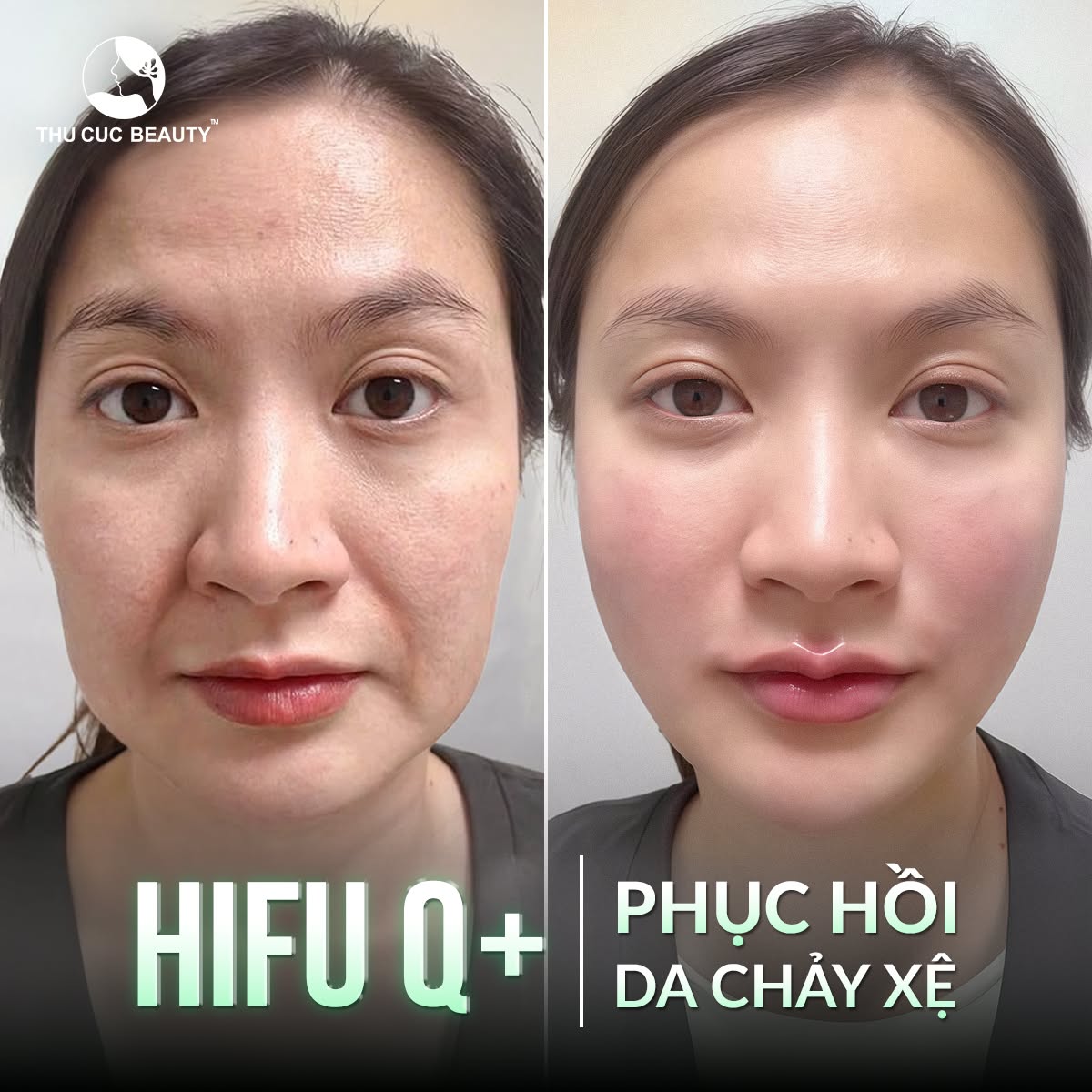 Bệnh Viện Thẩm Mỹ Thu Cúc Hà Nội Facebook ad: Nhắn tin ngay nhận tư vấn Miễn Phí
