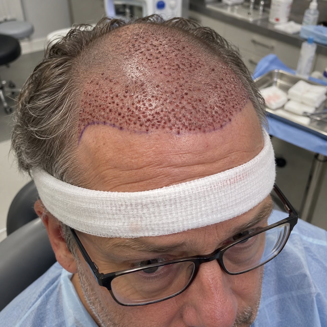 The Hair Growth Journal Facebook ad: My Transplant Was $16,400. Kiierr Addressed What I Missed