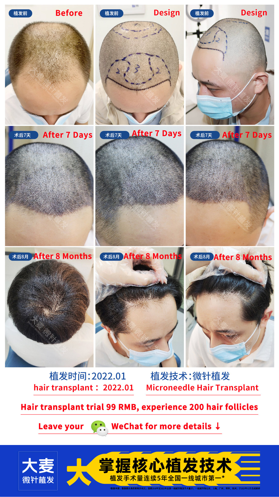 Barley Hair Transplant Facebook ad