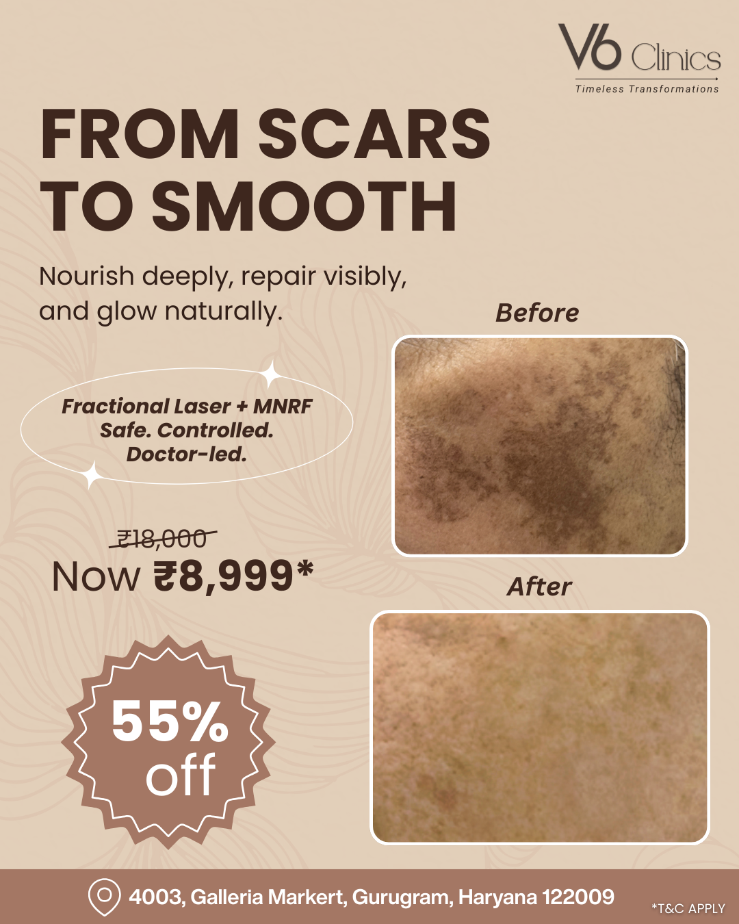 V6 Clinics Facebook ad: Say Goodbye to Acne Scars @ ₹8,999