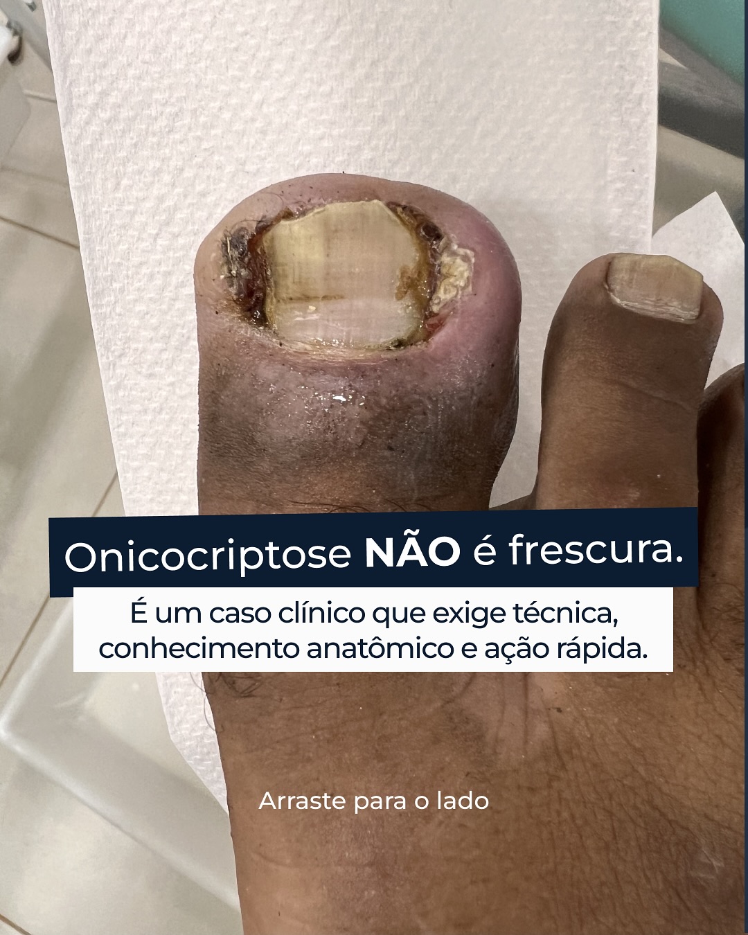 Jonas Campos Facebook ad: Aquela unha encravada que muitos subestimam pode esconder…