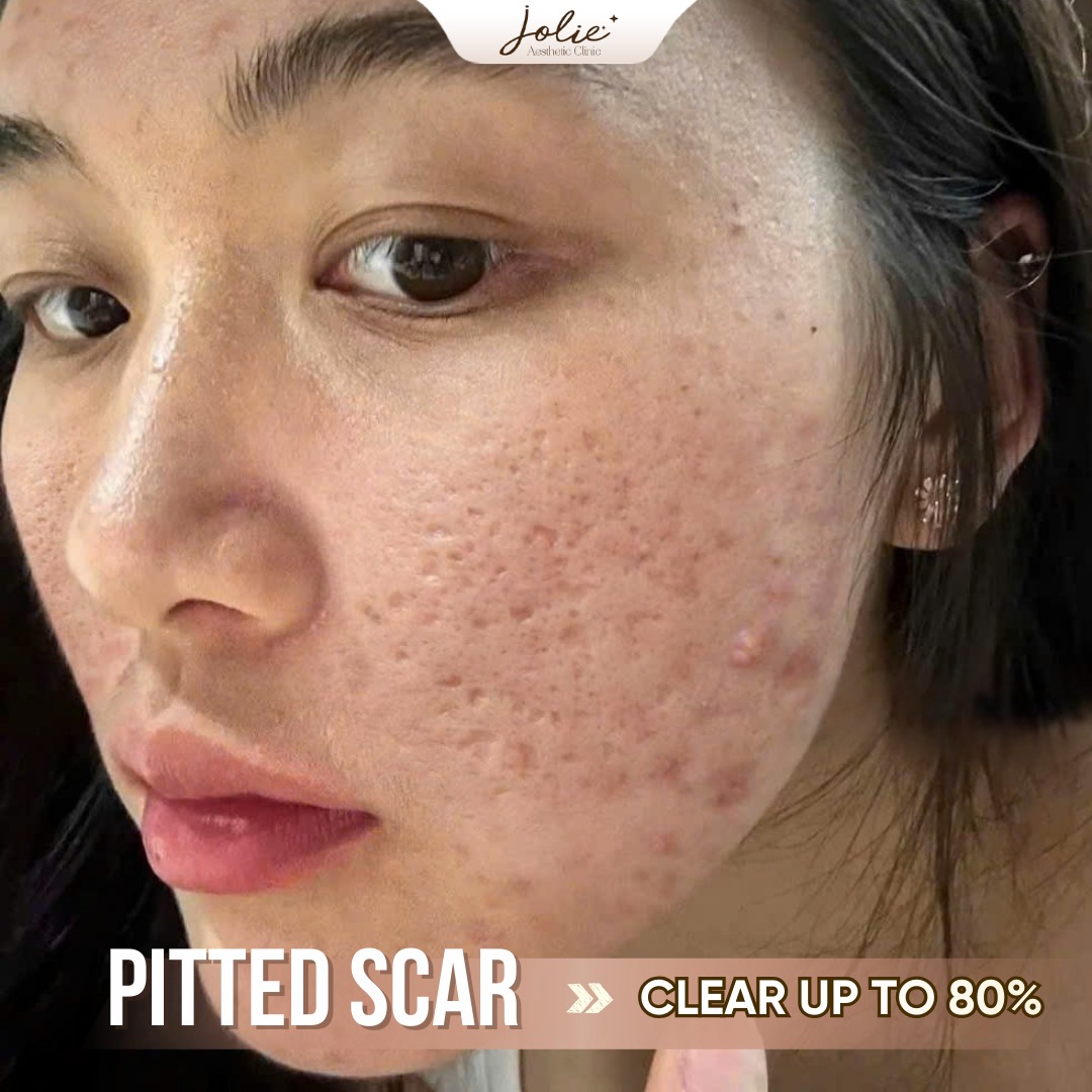 Jolie Beauty Clinic Facebook ad: Ms.A, 30s