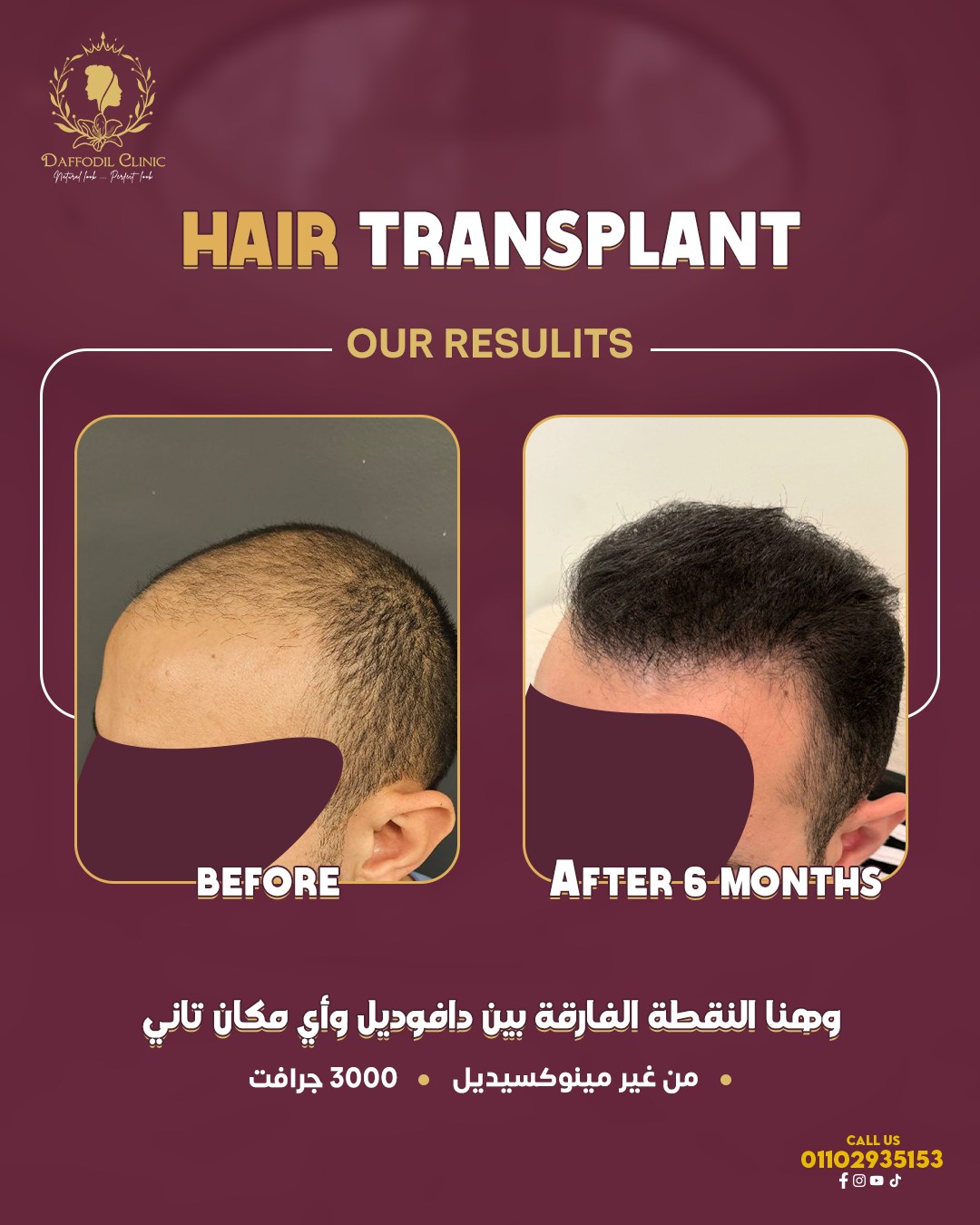 Daffodil Clinic Facebook ad: أصعب درجات الصلع الوراثي