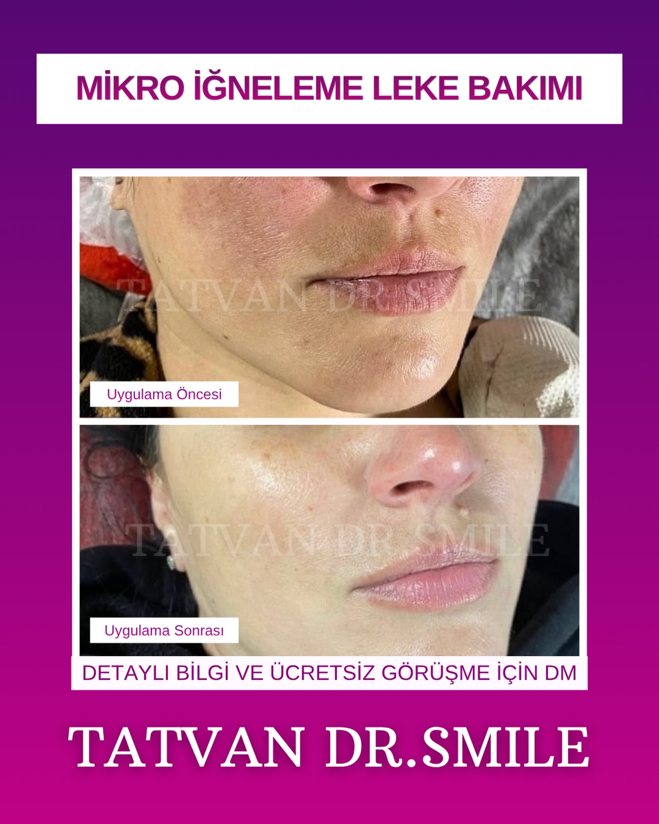 Drsmile.tatvan Facebook ad: Tatvan Dr Smile da 15-25 Temmuz'a özel kampanya. Sınırlı…