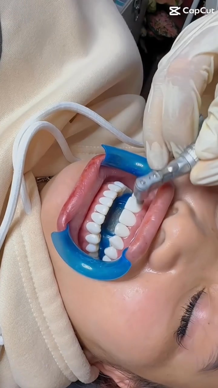 Dr.Smile ວຽງຈັນເຊັ່ນເຕີ Facebook ad: ແຂ້ວເຊຣາມິກ