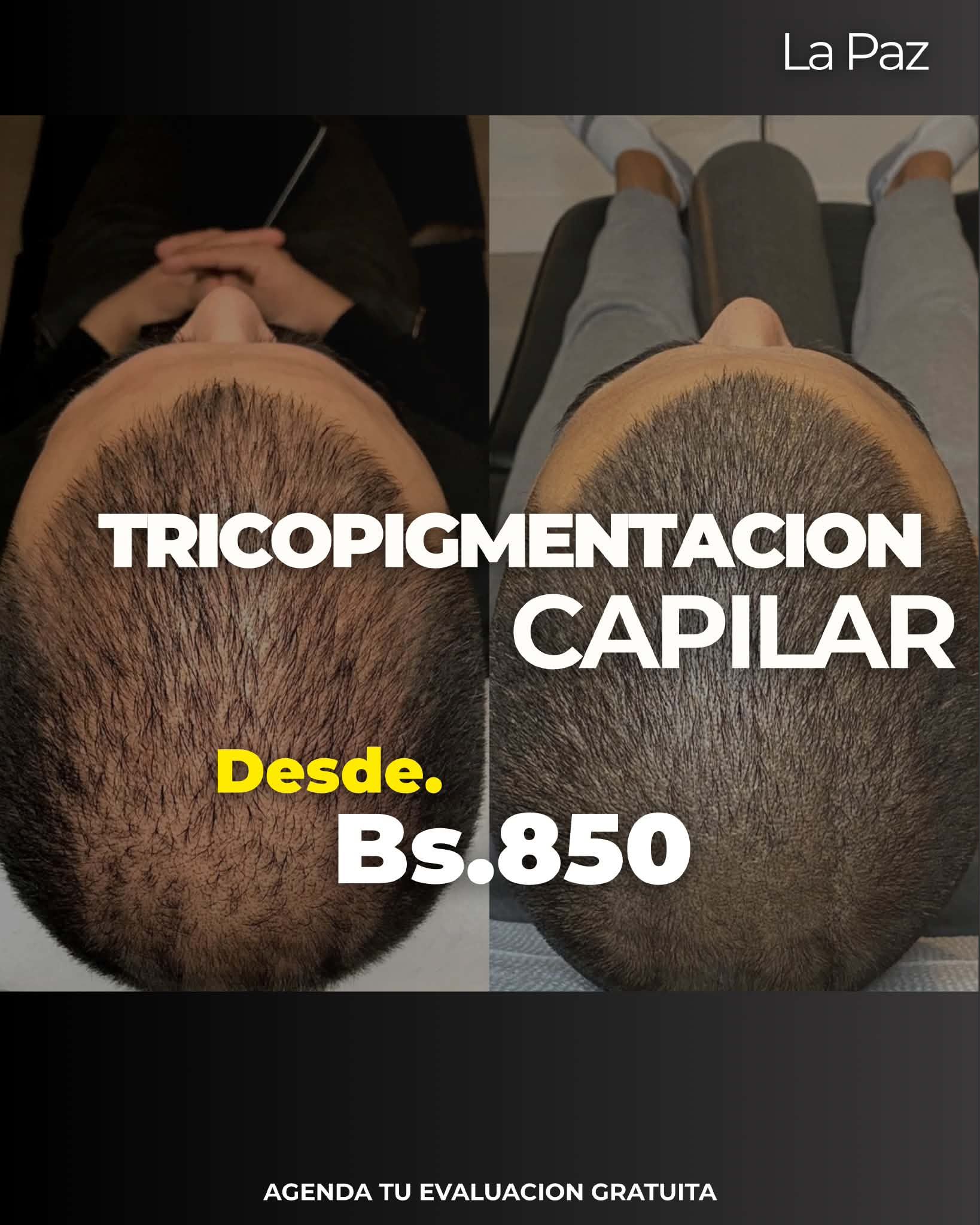 Lic. Zoe Eguez Facebook ad: La tricopigmentacion en un procedimiento no invasivo