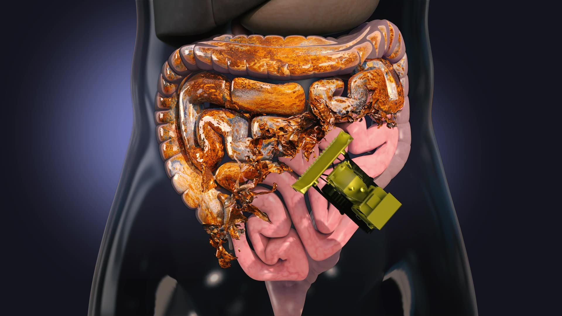 ProCombo - probiotic + prebiotic Facebook ad: Un sinbiotic puternic salvează abdomenul