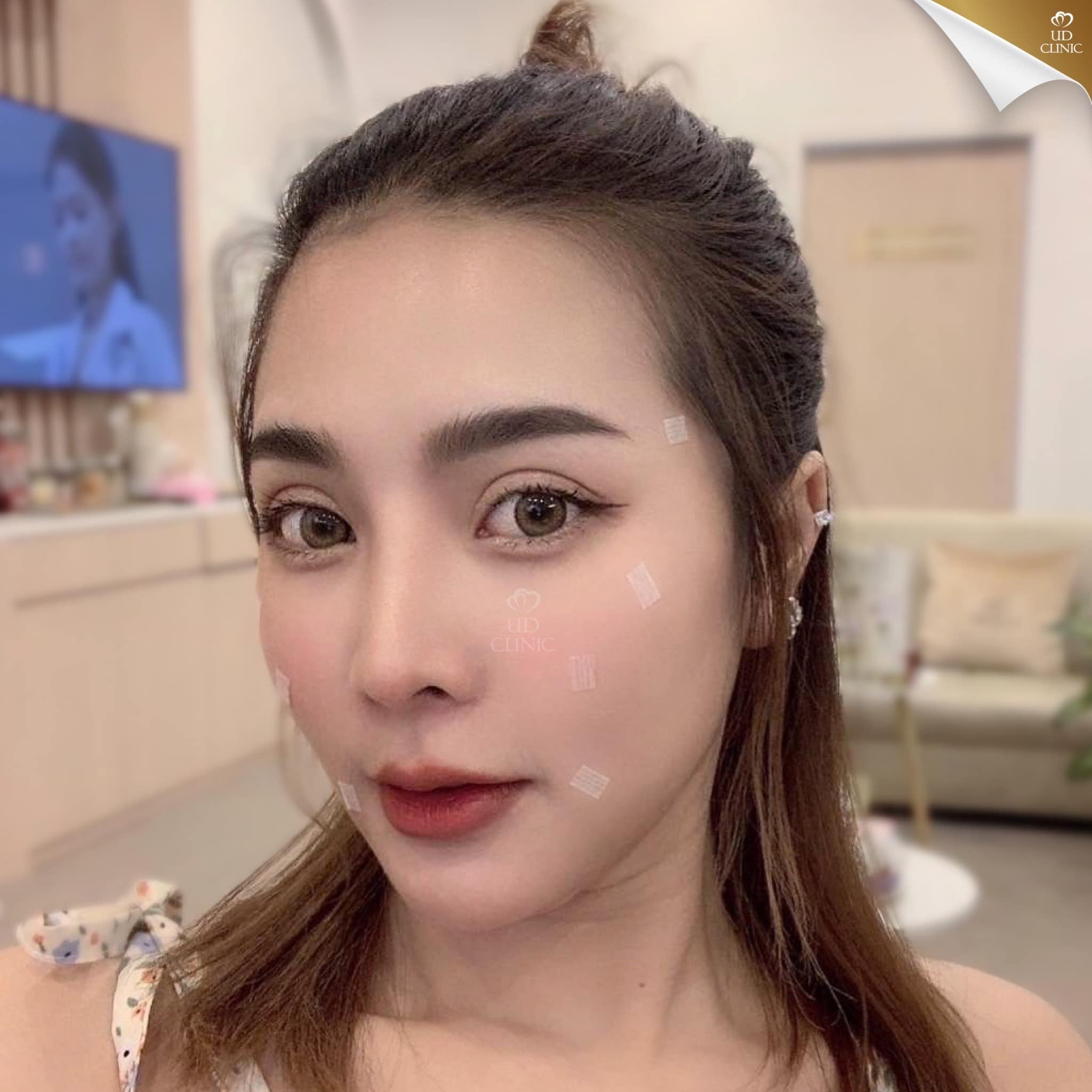 UD Clinic Facebook ad: 5,900 / cc ได้ทั่วหน้าทุกบริเวณ แกะกล่องสแกนรับกลับได้ UD…