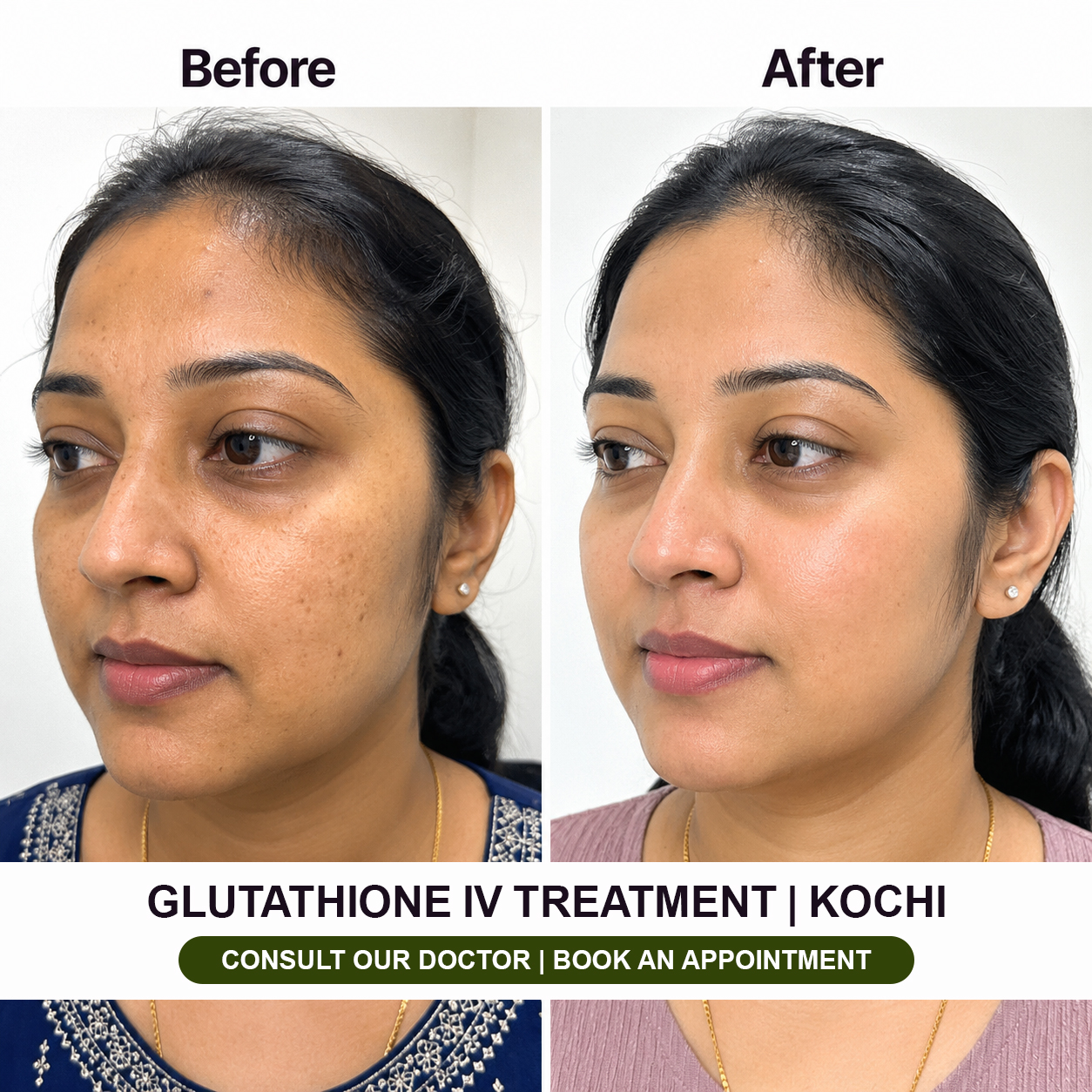 Dolce Estetica Facebook ad: KOCHI | Glutathione IV Therapy