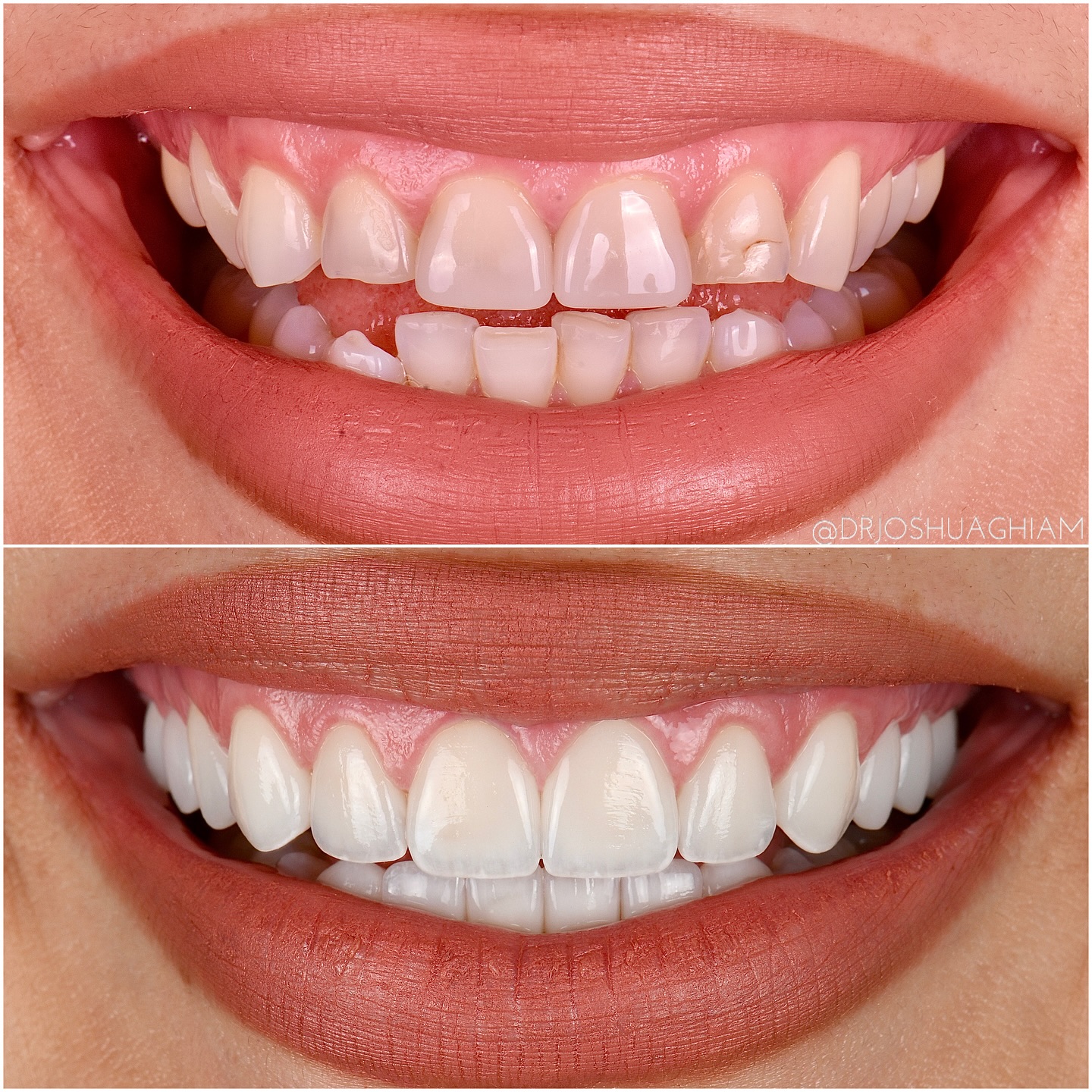 LA Smiles Dental Spa Facebook ad: Upper and Lower Porcelain Veneer Smile Makeover.