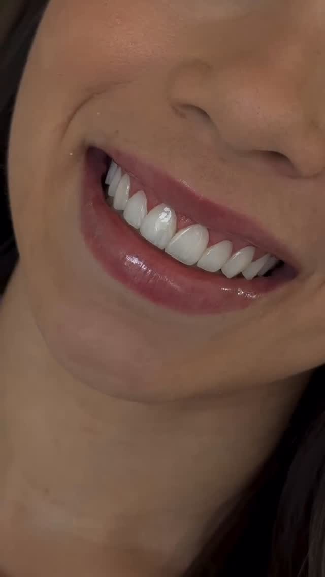 Sonrisa Perfecta Facebook ad: Diseño de sonrisa estratificado con carillas de resina…