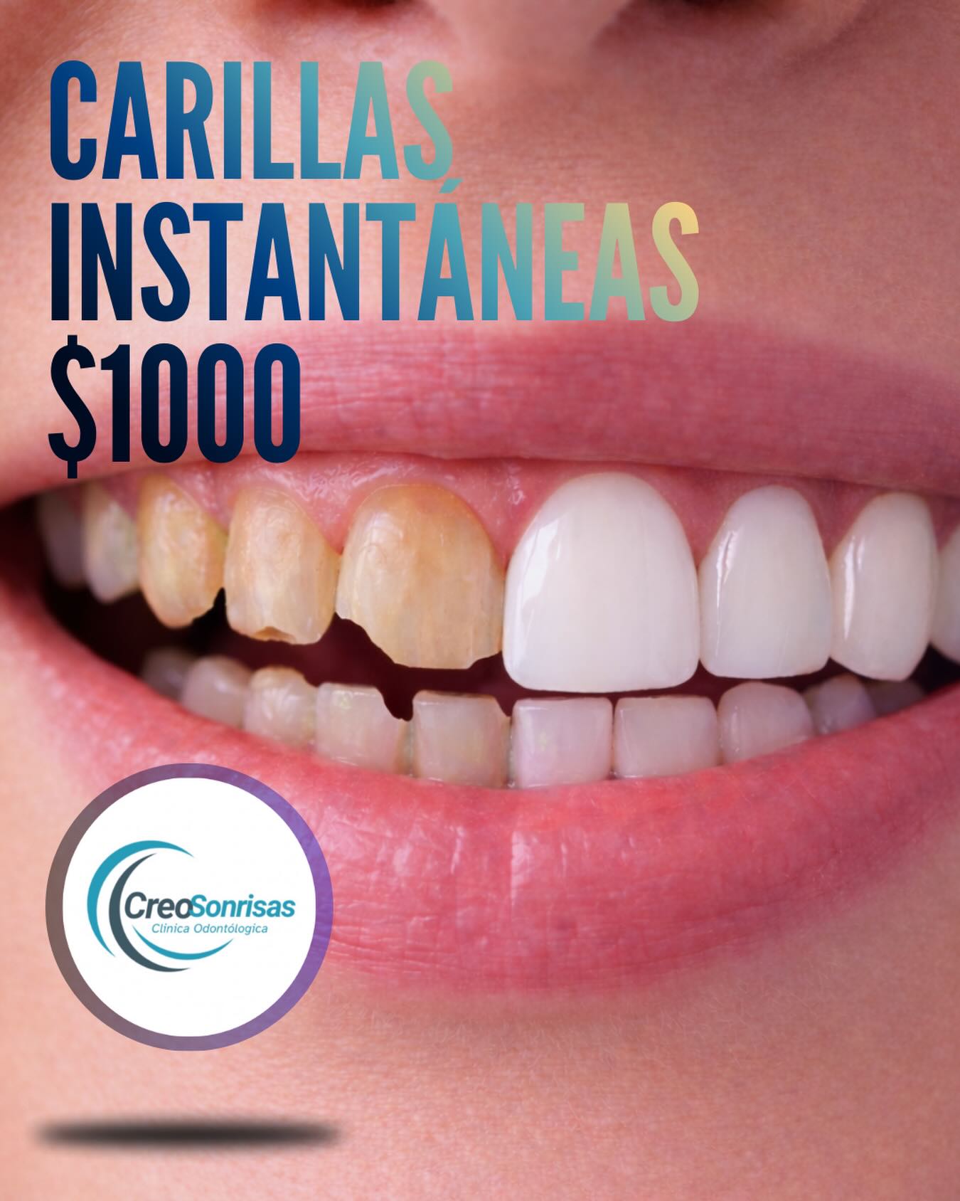 Creo Sonrisas Facebook ad: Carillas de resina para transformar tu sonrisa sin…